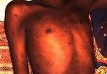 Les hépatites, maladies infectieuses dont plusieurs catégories de gens courent un risque