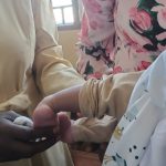 Burundi : 15 ans de lutte contre le pied bot, des avancées encourageantes malgré les défis